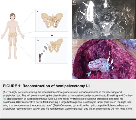 hemipelvectomy female|chondrosarcoma stories.